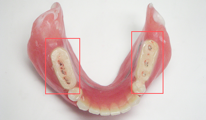 リハビリ用義歯には特殊な加工がされています
